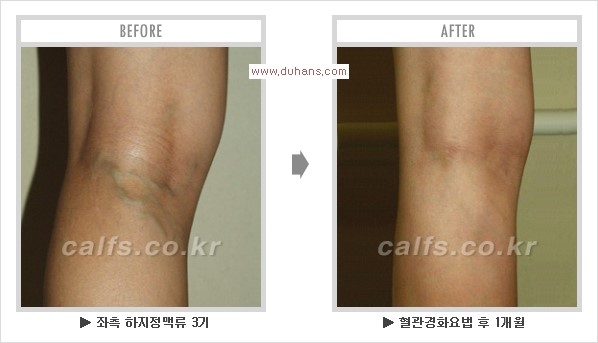 ⁠⁠[두한성형외과 경쟁력 멀티종아리성형] - [종아리성형 전후 주의해야 할 사항] 관련 이미지 13