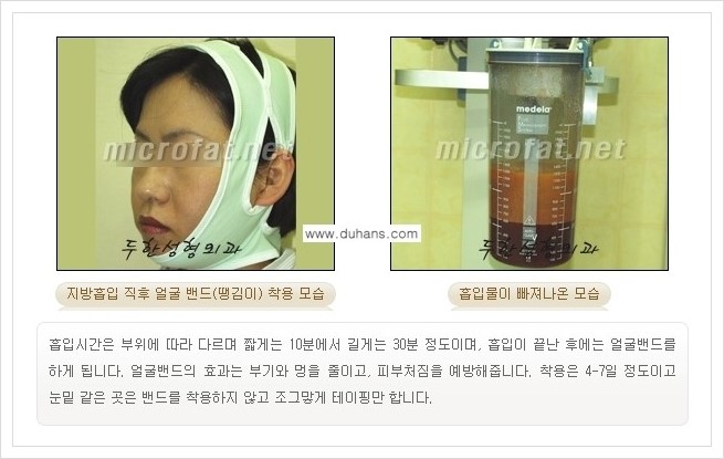 [두한성형외과 경쟁력 지방이식] - [지방이식 부작용 교정 안내 2.] 관련 이미지 4