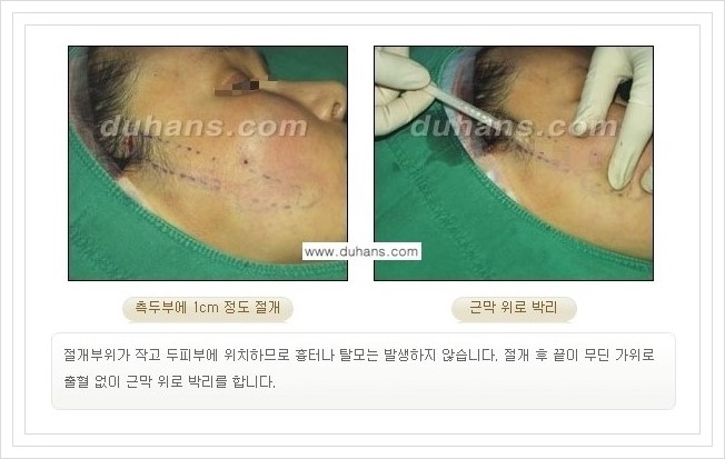 [두한성형외과 경쟁력 주름성형] - [회복과 일상으로의 복귀가 빠른 주름교정 엔도타인 리프팅] 관련 이미지 15