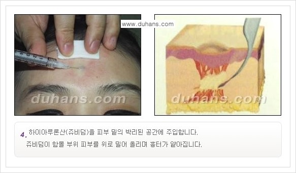 [두한성형외과 경쟁력 함몰 흉터 교정] - [동시에 3가지 시술로 효과적인 함몰 흉터 교정 안내] 관련 이미지 7