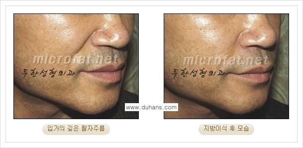 [두한성형외과 경쟁력 미세지방이식] - [입가주름, 팔자주름 교정 안내] 관련 이미지 14