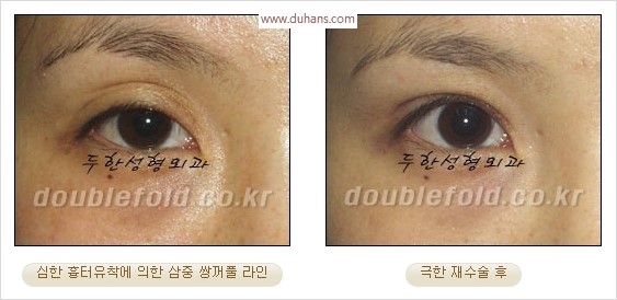 [두한성형외과 경쟁력 눈성형] - [극한 재수술, 함몰된 눈꺼풀 라인교정, 안검하수(졸리운 눈매)] 관련 이미지 7