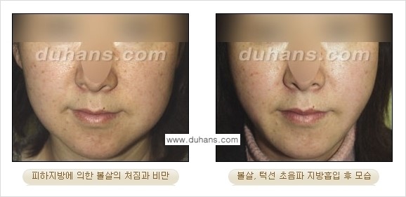 ​​​﻿[두한성형외과 경쟁력 간편지방흡입] - [볼살지방흡입, 턱선지방흡입 시술 과정의 안내] 관련 이미지 9