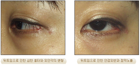 [Duhan Plastic Surgery Double Eyelid Revision] - [Inner Corner Revision, Outer Corner Revision] image 7