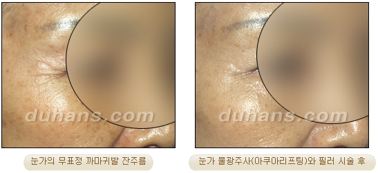 [두한성형외과 주름개선] - [주름교정 방법] 관련 이미지 21