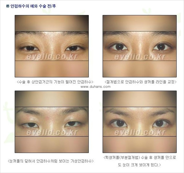 [두한성형외과 경쟁력 눈성형] - [안검하수와 몽고주름에 대한 자주하는 질문과 답변] 관련 이미지 2