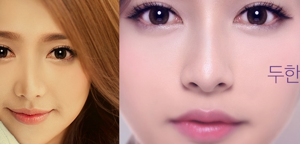 [두한성형외과 지방이식] - [입가팔자주름] 관련 이미지 1