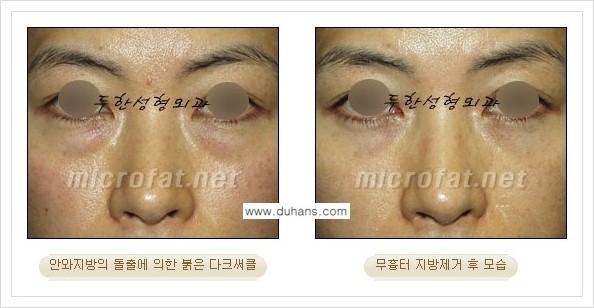 [두한성형외과 경쟁력 눈밑성형] - [눈밑지방제거, 눈위지방제거 안내 1.] 관련 이미지 19