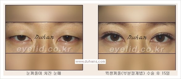 [두한성형외과 경쟁력 눈성형, 쌍꺼풀 수술] - [퀵쌍꺼풀(부분절개법)의 수술 안내] 관련 이미지 13