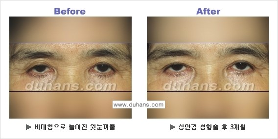 [두한성형외과 NO.1 눈성형] - [상안검 수술에 대한 정보] 관련 이미지 7