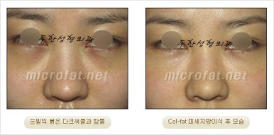 두한성형외과 눈밑수술 - 다크서클 수술 전후 관리 안내 관련 이미지 6