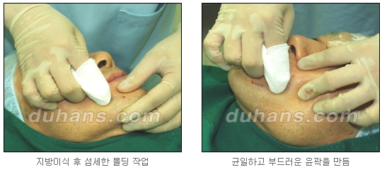 [두한성형외과 얼굴자가지방이식] - [지방이식 과정] 관련 이미지 8
