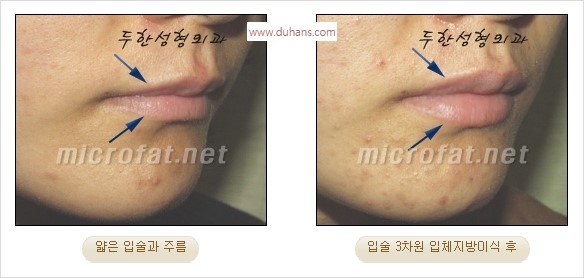 ​​[두한성형외과 경쟁력 미세지방이식] - [볼륨감 있는 입술성형] 관련 이미지 18
