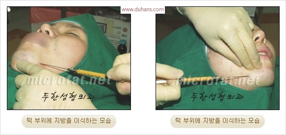 [두한성형외과 경쟁력 안면윤곽 교정] - [자연스럽고 균형있는 턱으로의 복원 미세지방이식과 간편 사각턱 보톡스 안내] 관련 이미지 11