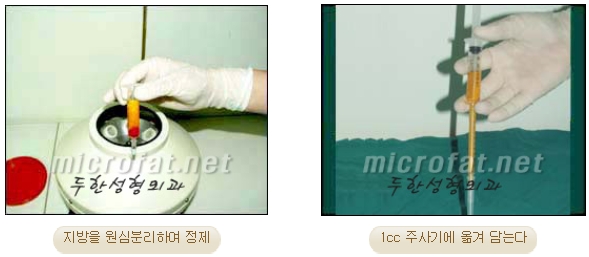 [두한성형외과 지방이식] - [다크써클, 눈​밑주름] 관련 이미지 7
