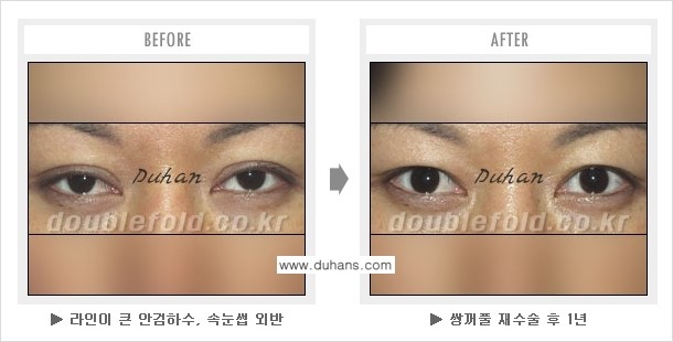 [두한성형외과 경쟁력 쌍꺼풀 재수술, 극한 재수술] - [쌍꺼풀 재수술로 인해 흉살이 두터운 경우] 관련 이미지 4