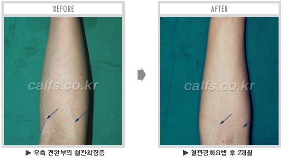 [종아리성형 두한성형외과] - [종아리수술에 대한 자주하는 질문과 답변 모음] 관련 이미지 40