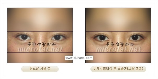 [두한성형외과 경쟁력 눈밑성형] - [눈밑 다크써클과 눈밑 애교살과의 관계] 관련 이미지 7