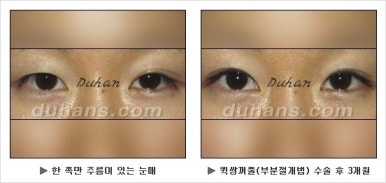 Best Place for Double Eyelid Revision Surgery, Duhan Plastic Surgery - Partial Incision Eye Revision Surgery image 21