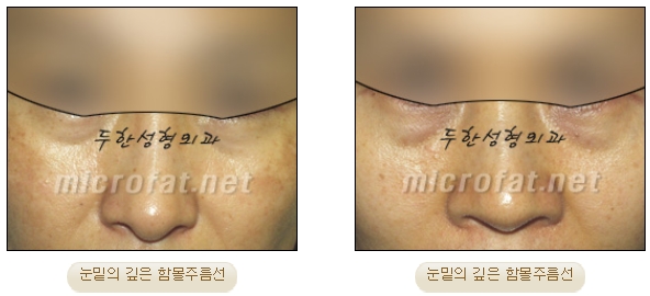 [두한성형외과 지방이식] - [다크써클, 눈​밑주름] 관련 이미지 3
