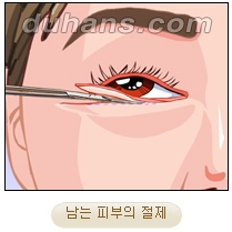 [두한성형외과 안검성형] - [상안검, 하안검] 관련 이미지 20