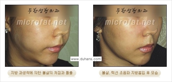 [두한성형외과 경쟁력 지방흡입] - [얼굴, 볼살, 턱살, 턱선의 초음파 지방흡입] 관련 이미지 12