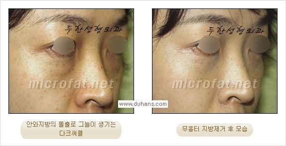 [두한성형외과 경쟁력 눈밑성형] - [과도한 눈밑지방제거의 부작용 후 눈밑지방재배치] 관련 이미지 7