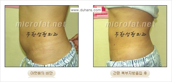 [두한성형외과 겨울엔 지방흡입] - [간편한 복부지방흡입 도전 2.] 관련 이미지 4