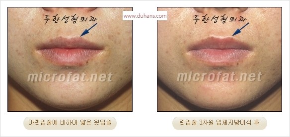 ​​[두한성형외과 경쟁력 미세지방이식] - [볼륨감 있는 입술성형] 관련 이미지 20