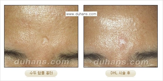 [두한성형외과 함몰 흉터 교정] - [동시에 3가지 시술로 효과적인 흉터의 교정 안내 ②] 관련 이미지 4