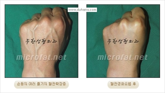 [두한성형외과 경쟁력 정맥류 치료] - [손, 손등, 손목혈관확장증, 팔혈관확장증에 질문과 답변] 관련 이미지 9
