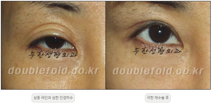 [Double Eyelid Surgery, Duhan Plastic Surgery] - [Extreme Revision Eye Surgery to Correct a Damaged Line] image 27