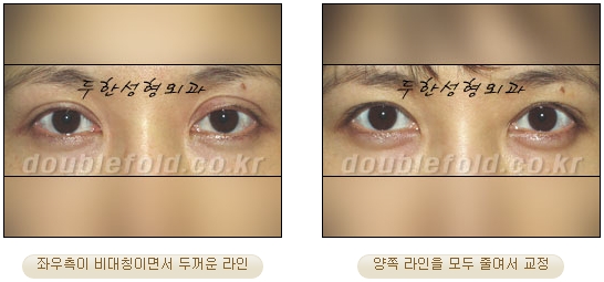 [두한성형외과 쌍커풀수술] - [눈성형 방법에 대한 자주하는 질문과 답변] 관련 이미지 37