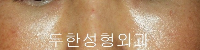 [Duhan Plastic Surgery Dark Circles] - [Under-Eye Dark Circle 5-Step Solution] image 48