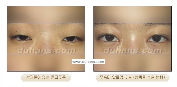 [두한성형외과 눈성형 FOCUS] - [몽고주름 제거(앞트임 제거) 수술 ①] 관련 이미지 7