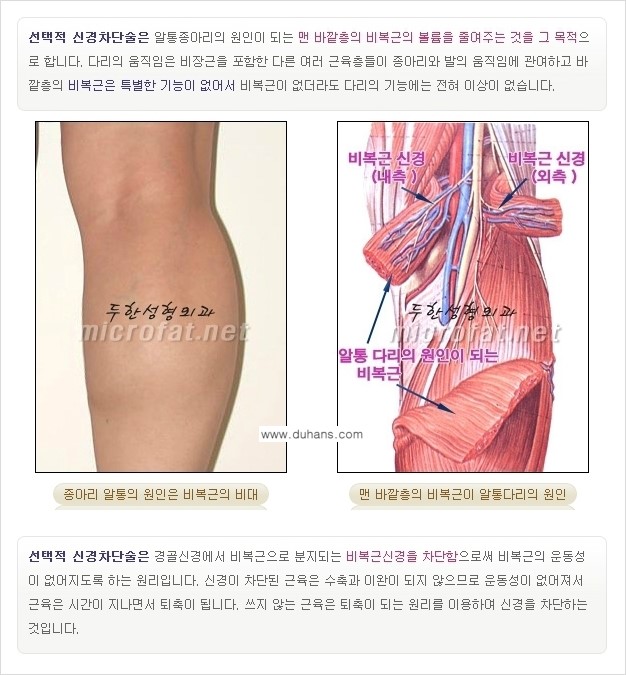 [두한성형외과 경쟁력 멀티종아리성형] - [초음파 유도 비절개 선택적 신경차단술의 효과] 관련 이미지 6