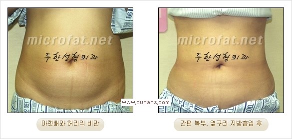 [두한성형외과 경쟁력 간편지방흡입] - [복부(뱃살) 비만 간편지방흡입] 관련 이미지 18