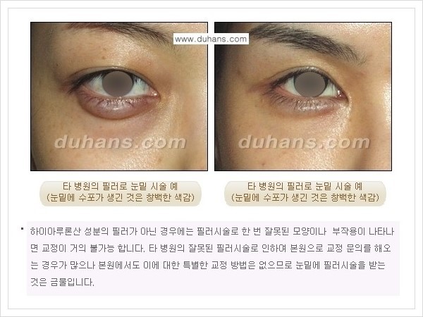 [두한성형외과 경쟁력 주름성형] - [필러 사용에 대한 주의점 안내] 관련 이미지 5