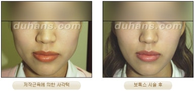 [Duhan Plastic Surgery Clinic Aesthetic Procedures] - [Square Jaw Botox] image 7