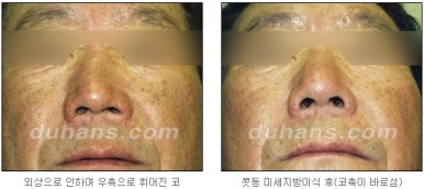 [두한성형외과 코재수술] - [코성형 안내] 관련 이미지 6