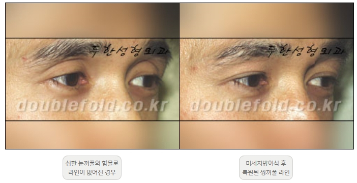 [두한성형외과 쌍커풀재수술] - [풀린 쌍커풀라인 교정] 관련 이미지 19