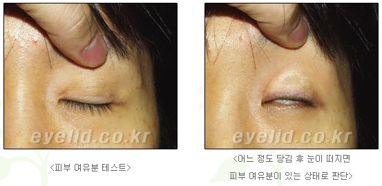Duhan Plastic Surgery Eye Surgery - Are You a Candidate for Double Eyelid Revision Surgery?! image 3