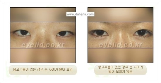 ​[두한성형외과 경쟁력 눈매성형] - [눈의 가로길이를 키우는 앞트임, 뒤트임 수술] 관련 이미지 4