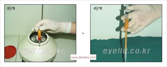 [두한성형외과 경쟁력 안검성형] - [꺼진 눈꺼풀, 눈꺼풀 함몰, 윗눈꺼풀 미세지방이식] 관련 이미지 7