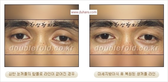 [두한성형외과 경쟁력 쌍꺼풀 재수술 리더] - [풀린 쌍꺼풀, 풀려버린 쌍꺼풀 재수술 방법 안내] 관련 이미지 5