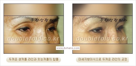 [두한성형외과 경쟁력 쌍꺼풀 재수술] - [쌍꺼풀 재수술 과정] 관련 이미지 96