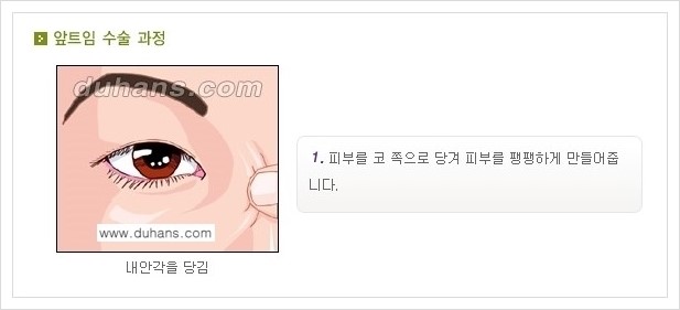 [두한성형외과 경쟁력 눈성형] - [앞트임 수술(몽고주름 제거) 안내 ②] 관련 이미지 1