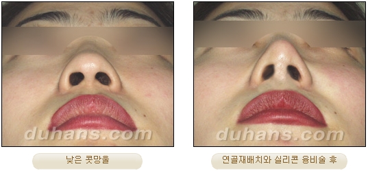 [두한성형외과 코성형] - [코재수술 방법] 관련 이미지 31