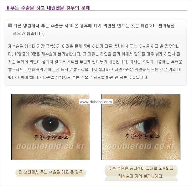 [두한성형외과 경쟁력 있는 쌍꺼풀 재수술] - [극복해야 할 극한의 상황과 문제들] 관련 이미지 12