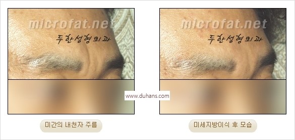 [두한성형외과 경쟁력 동안성형 리더] - ​[미간주름, 이마주름, 안검성형, 이마거상술, 눈썹거상술] 관련 이미지 14